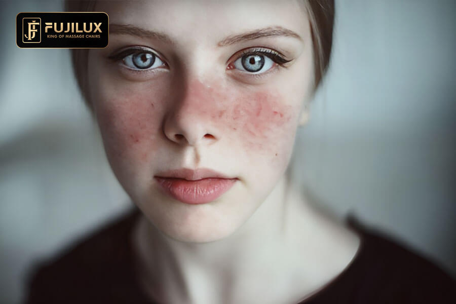 bệnh lupus ban đỏ giai đoạn đầu đều có tình trạng nổi hồng ban