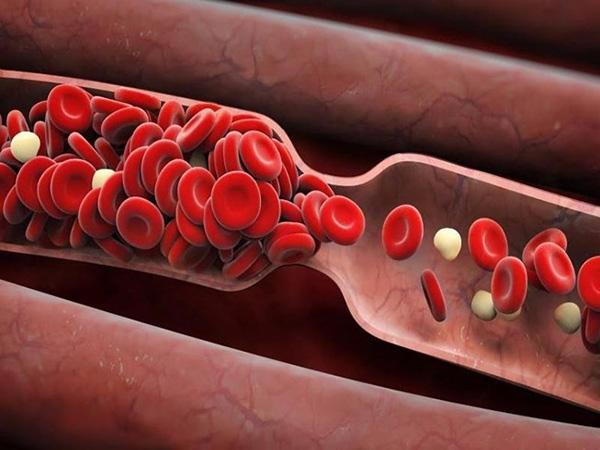 4 loại tắc nghẽn mạch máu thường gặp