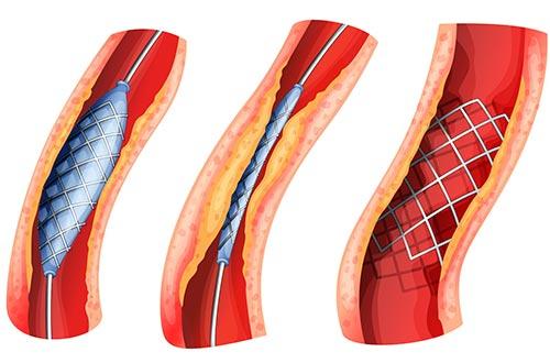 Duy trì 5 thói quen có lợi cho mạch máu ngăn ngừa bệnh tim mạch