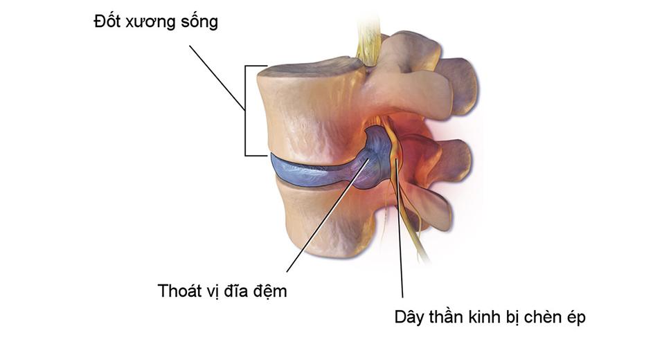 Tổng hợp kiến thức tìm hiểu bệnh thoát vị đĩa đệm