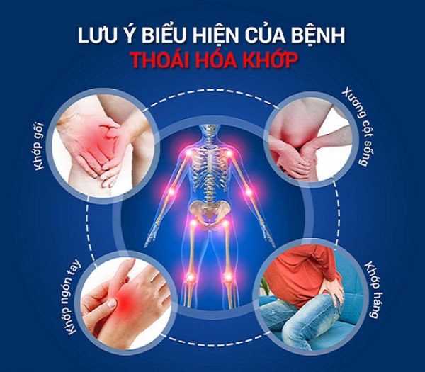 Thoái Hóa Khớp Và Các Dấu Hiệu Nhận Biết Sớm