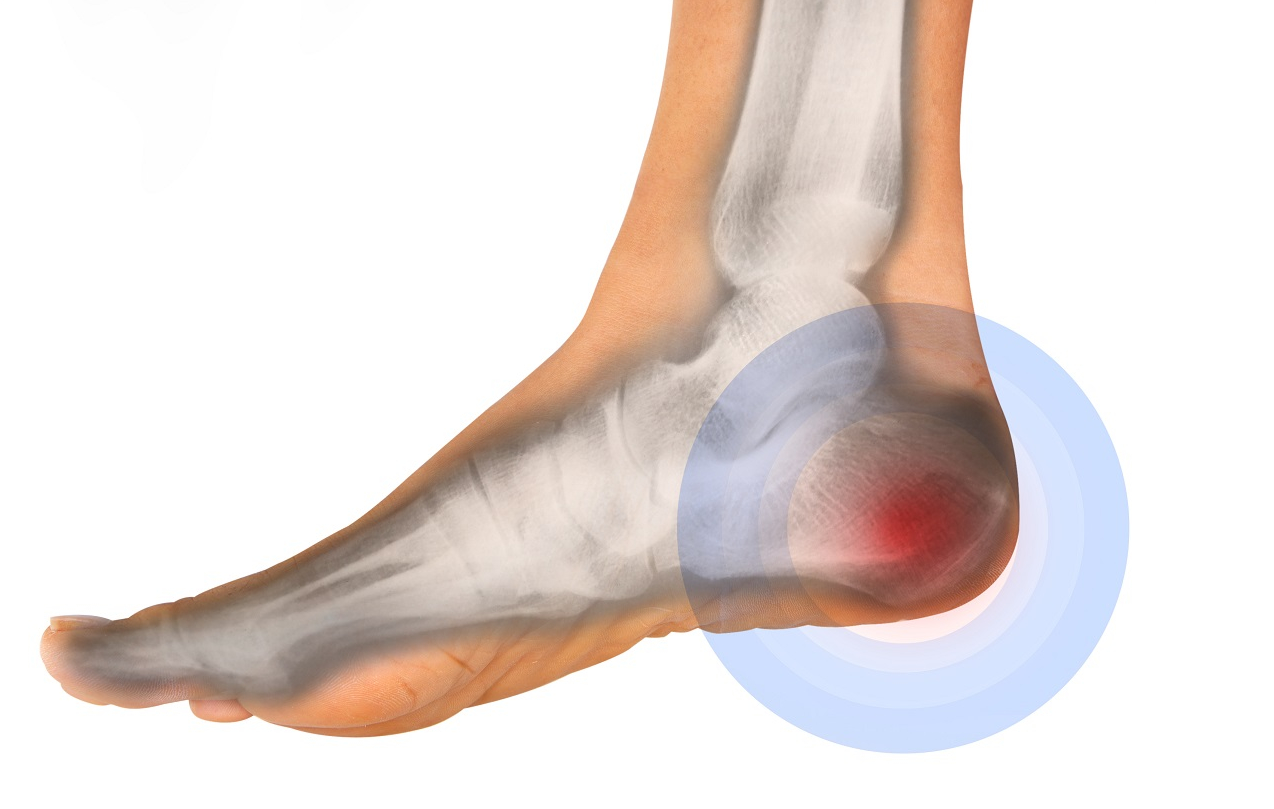 Chấn thương gót chân gây ra đau đớn, khó chịu cho các cầu thủ khi thi đấu.